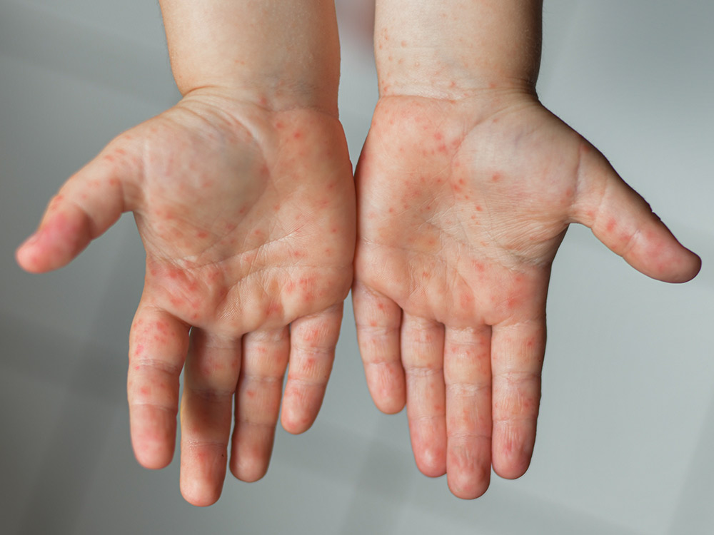 Home Remedies For Hand, Foot, And Mouth Disease